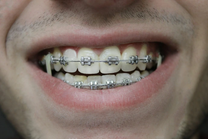 Boca con brackets de ortodoncia
