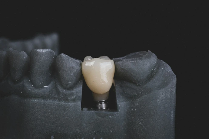 Implante dental con corona