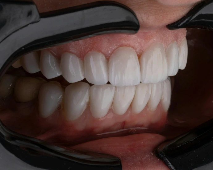 Sonrisa con dientes sanos