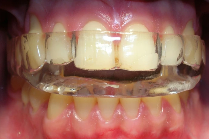 Placa de oclusión dental